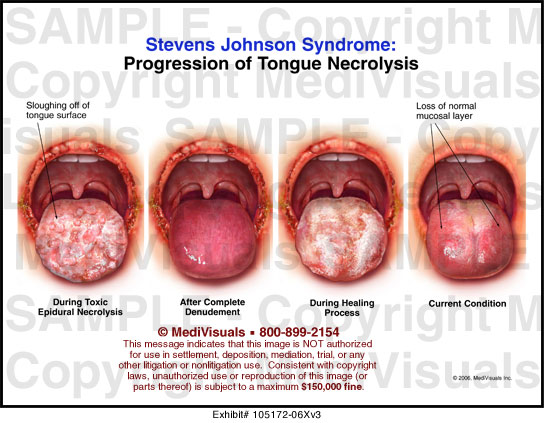 What is SJS « Stevens Johnson Syndrome Foundation
