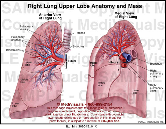 Medivisuals Right Lung Upper Lobe Anatomy and Mass Medical Illustration
