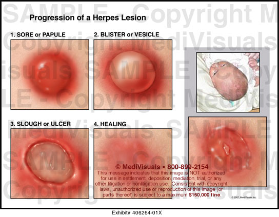 genital herpe stages