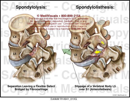 Spondylolysis   wikipedia